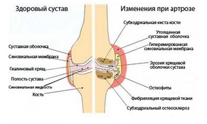 artroza romana)