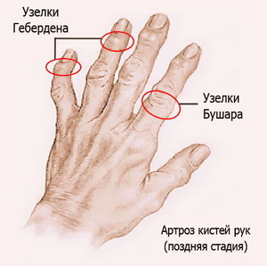artroza ruku učinkovit tretman)