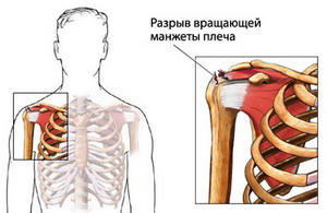 Повреждение вращающей манжеты плеча